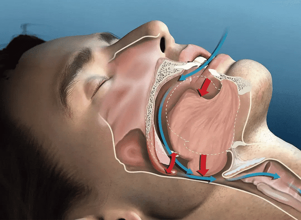 Benzi Nazale Invizibile